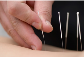 Acupuncture for snoring