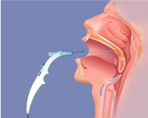 Image demonstrating a surgery to reduce snoring and help with insomnia